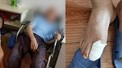 养老院回应老人脚趾长蛆：护理人员变动 不知老人有灰指甲