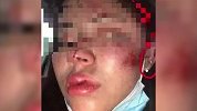 女子深夜遭3名男子调戏殴打：头部及面部多处受伤
