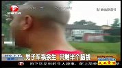 男子车祸余生 只剩半个脑袋