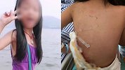 江西8岁女孩遭烈性犬咬伤昏迷住院23天 家属欲追究狗主人刑责