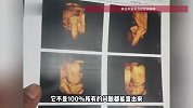 试管婴儿出生右脚缺4个脚趾，医院回应：超声检查有局限性