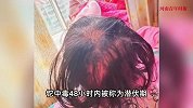3岁女童突然脱发、眼神呆滞、无法正常行走，竟是中毒！家长回应