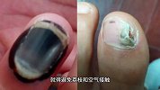 剥荔枝指甲变黑色怎么去掉