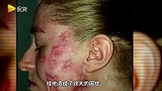 花季少女无法护肤？美国少女因得皮肤病满脸红肿疤痕增生遭身边人远离，心理承受压力过