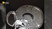 巨无霸肿瘤！男孩脸的正中央生长出肉瘤，足有柚子般大！
