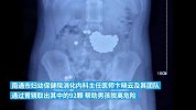 男童吞下103颗比黄豆大的钢珠，医生一小时取出92颗