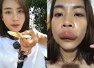 福建女子吃蜂巢被蛰成香肠嘴 当事人：喝水都漏