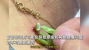女子让螳螂吃掉颈后肉瘊子，称有点疼，像针扎一样！医生：不科学