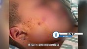 被邻居放炮炸伤截肢男孩母亲发声：治疗花销很大，怕拿不到赔偿