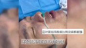 海归留学男子麻醉后狂飙英语，媳妇：医生提问，他也用英语回答