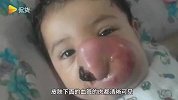 天堂没有痛苦！女孩脸上正中央有巨大肿瘤覆盖鼻子和嘴巴，在手术前去世！