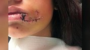 少女跟爱犬亲密自拍 不成想遭德牧疯狂咬脸险毁容