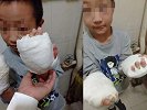 9岁男童疑被继母用开水深度烫伤 老师报警后刑警介入