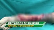 男子被蚊子咬后险些截肢 前后花费50多万