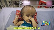 孟加拉国一男婴头大如外星人，出生后便遭父亲抛妻弃子！