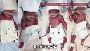 5胞胎（1男4女）顺利出生！六千万分之一概率的奇迹！