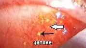女子长期熬夜追剧，眼睛里竟长了5颗结石，医生提醒：这类人要注意