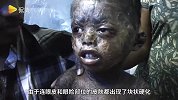 皮肤变成鳞片状！非洲小男孩皮肤成硬块不断脱落超像一只蜥蜴！