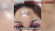 女子与丈夫打闹磕到额头，淤青肿胀变“熊猫眼”，本人辟谣：真是自己撞的，绝非家暴