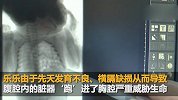 新生儿肠子和脾脏“跑”进胸腔 医护人员上演生死营救