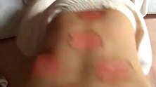 江西92名儿童被三伏贴灼伤 治疗项目暂停 卫健部门已介入调查