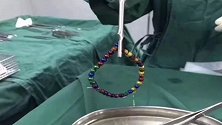 浙江1岁女童误吞36颗磁力珠 肠子被捅俩洞