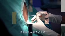 为什么剖腹产是局部麻醉，而人流却是全身麻醉医生道出了实情