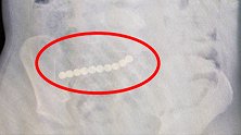惊呆了！男童体内藏14颗磁珠，差点丧命……