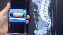 广东广州：男子将15厘米异物塞入体内，医生取出后都惊呆了