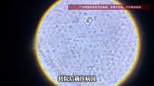 女童小区玩耍接触非洲大蜗牛，感染广州管圆线虫：治疗半年才停药出院