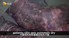行走的蜥蜴人！男子患皮肤病全身皮肤如蛇皮般，疾病也使其贫穷！