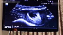 孕6周+2天的B超检查，第一次看到宝宝，像一粒花生米，好萌！