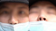 女子6年前花14万整容 致打呼噜严重遭退婚？