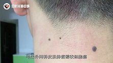 皮肤上的痣突然变大变黑，小心是黑色素瘤，拖久了会很麻烦