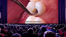 蛀牙真是被“蛀虫”咬的吗？3D动画演示全过程