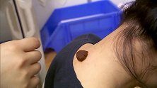 用三伏贴治疗 上海一3岁女童背上被灼伤