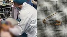 家长警惕！10个月大宝宝误食3厘米别针 医生5分钟取出