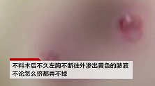 女子花6万做隆胸手术后频繁流黄色液体：老公看了都说恶心
