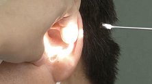 湖北武汉：男子用笔芯掏耳朵，笔帽掉进耳道深处出不来了