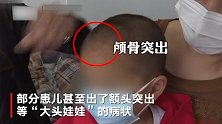 湖南永兴官方回应大头娃娃事件：涉事产品合格，幼儿患病原因待查