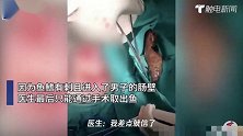 男子腹痛难忍肚子里面居然有条鱼:不小心坐到鱼上