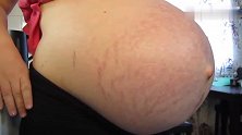 孕妈怀孕40周，肚子大到长满妊娠纹，怀孕妈妈真是太辛苦了