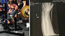 美国女运动员举330斤重杠铃手臂骨折 骨头发出断裂声