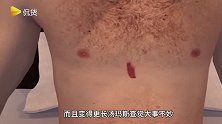 差点就成蜘蛛人！火柴头大的蜘蛛爬进男子的手术伤口中，在体内存活了三天！
