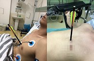 疼！男子在家玩弩箭竟射中自己心口 离心脏仅1厘米