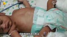 我也不想自燃的！男孩在出生后三个月内出现4次自燃现象，并没接触火种！