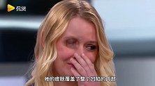 被眼睛所遮蔽的美貌！国外女子因患眼部肿瘤不得已摘除了右眼球，所幸已无生命危险！