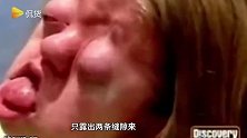 似“外星人”女孩！女孩因病额头只能保持奇怪姿势，大脑却完全正常！