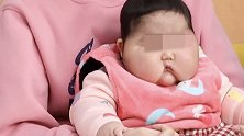 福建漳州：女婴用抑菌霜成“大头娃娃”？卫健委回应了