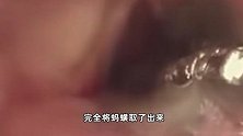 女子咳血半个月气管里取出一条蚂蟥！疑与山泉沟渠水有关